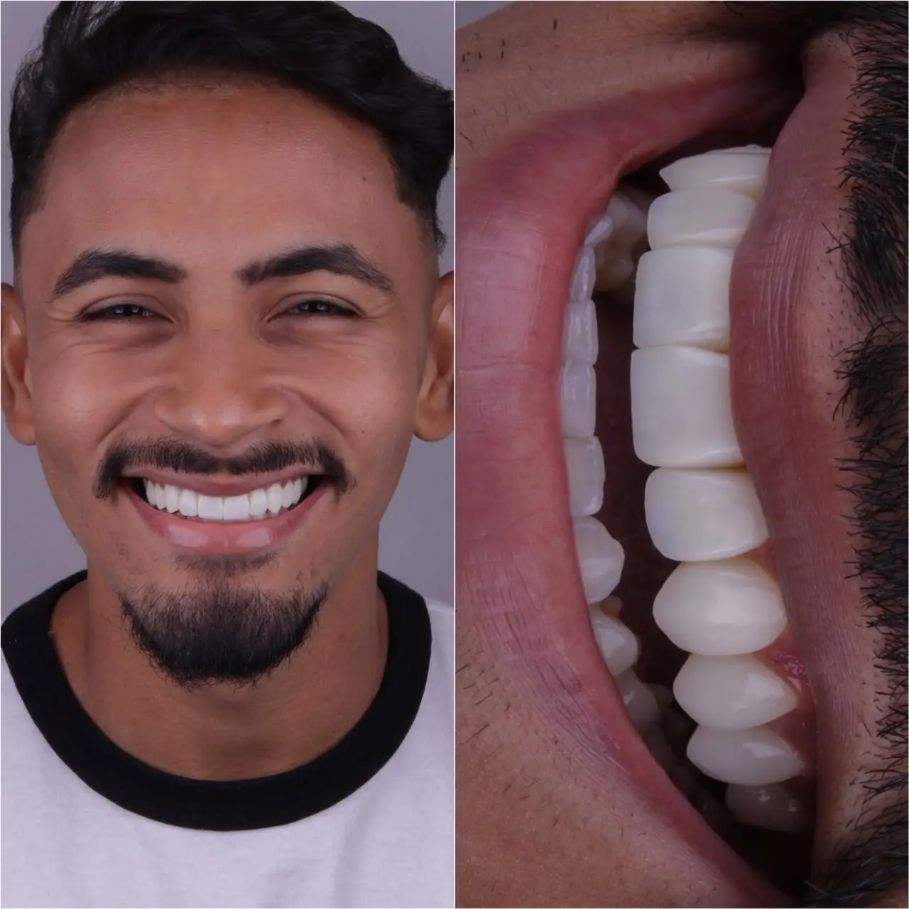 Antes e depois do tratamento de facetas em resina Santo André