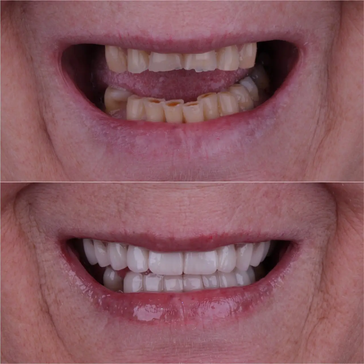 Tratamento com lentes híbridas e prótese dentária