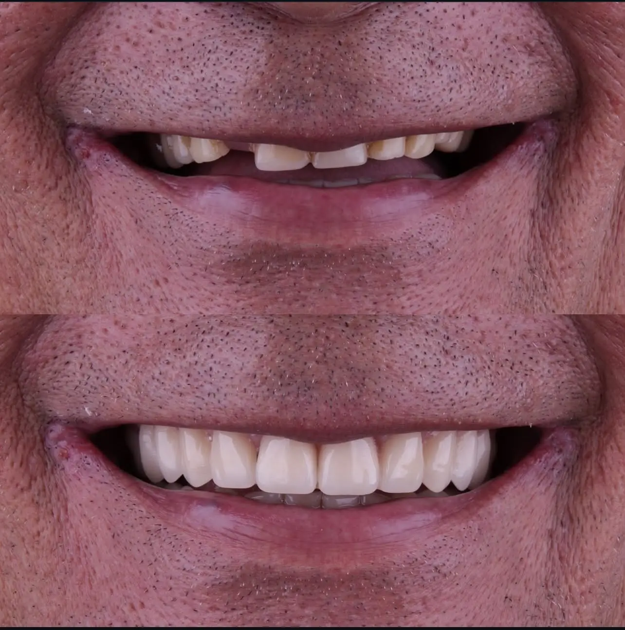 Antes e depois de prótese protocolo sobre implantes